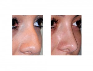 Teen Rhinoplasty result oblique view Indianapolis Dr Barry Eppley