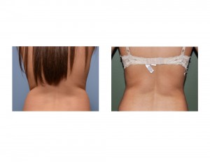 es flank liposuction result back view