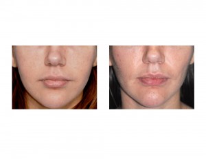 Buccal Lipectomy and Perioral Mound Liposuction result front view Dr Barry Eppley Indianapolis