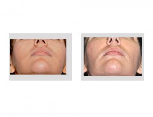 Buccal Lipectomy and Perioral Mound Liposuction result submental view Dr Barry Eppley Indianapolis