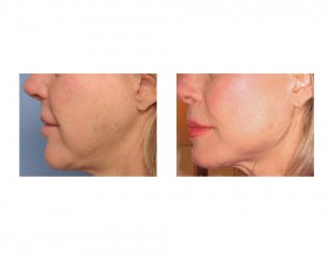Female Jaw Angle Implants result left side view DR Barry Eppley Indianapolis