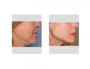 Female Jaw Angle Implants result right side view Dr Barry Eppley Indianapolis