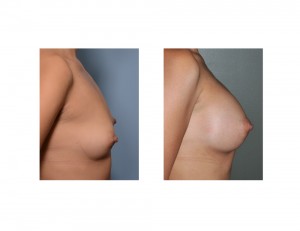 Hispanic Breast Augmentation result side view Dr Barry Eppley Indianapolis