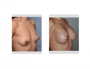 Hispanic Breast Augmentationresult oblique view Dr Barry Eppley Indianapolis