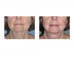 Necklift result Dr Barry Eppley Indianapolis front view