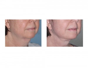 Necklift result Dr Barry Eppley Indianapolis oblique view