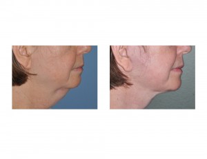 Necklift result Dr Barry Eppley Indianapolis side view