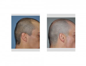 Occipital Skull Augmentation with Neck Fat Injections result Dr Barry Eppley Indianapolis