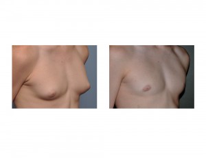 Teenage GYnecomastia Reduction result oblique view Dr Barry Eppley Indianapolis