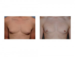 Teenage GYnecomastia Reduction results front view Dr Barry Eppley