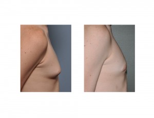 Teenage Gynecomastia Reduction results side view Dr Barry Eppley Indianapolis