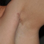 Transaxillary Silicone Breast Augmentation Scar Dr Barry Eppley Indianapolis