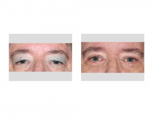 Visual Field Obstruction Blepharoplasties result front view