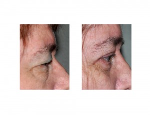 Visual Field Obstruction Blepharoplasties result side view