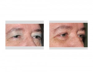 Visual Field Obstruction Browlift Blepharoplasties result oblique view Dr Barry Eppley Indianapolis