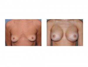 Breast Augmentation result with left lower pole crease front view Dr Barry Eppley Indianapolis
