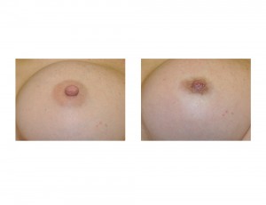 Female Nipple Reduction intraop result Dr Barry Eppley Indianapolis