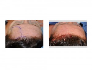 Forehead Hydreoxyapatite Cement Augmentation with Pretrichjal Incision Dr Barry Eppley Indianapolis