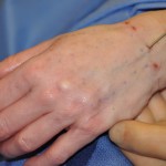 Hand Rejuvenation by Fat Injections Dr Barry Eppley Indianapolis