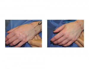 Hand Rolling for Fat Injections Dr Barry Eppley Indianapolis