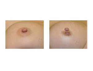 Nipple Reduction Wedge Technique Dr Barry Eppley Indianapolis