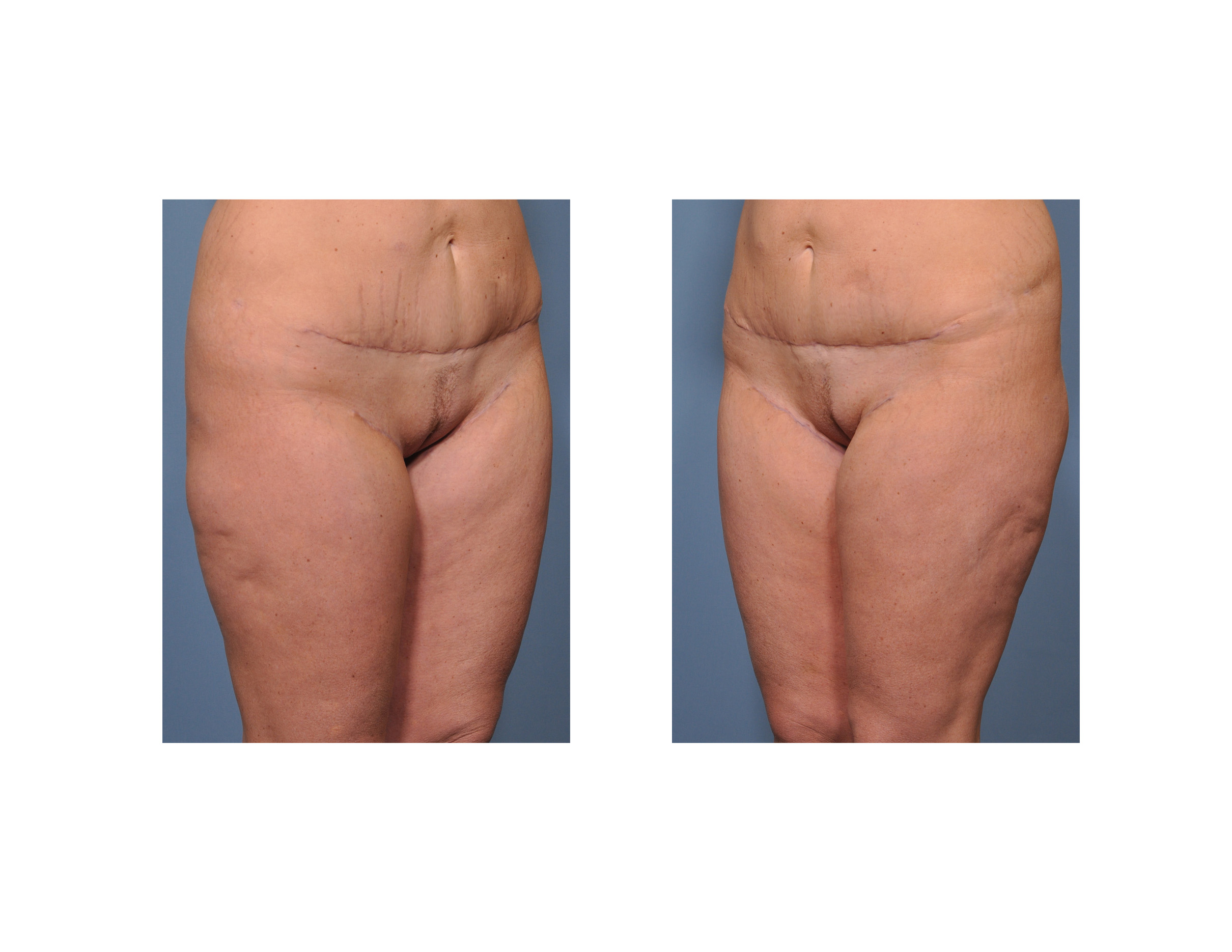 Thigh Lift Scars: Where Are Incisions For Different Thigh Lifts Made?
