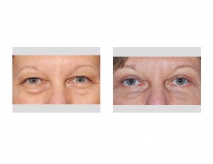 Upper Blepharoplasty Indianapolis Dr Barry Eppley