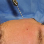fat injections to forehead dr barry eppley indianapolis