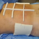 Abdominal Etching Foam Dressing side view Dr Barry Eppley Indianapolis