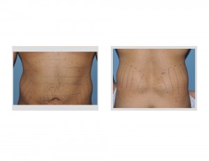 Abdominal and Flank Harvest Sites fort Deltoid Augmentation by Fat Injections Dr Barry Eppley Indianapolis