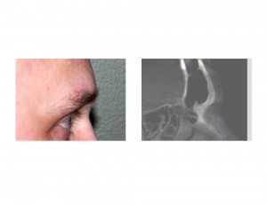 Brow Bone Rerduction by Burring Dr Barry Eppley Indianapolis Preoperative X-Ray