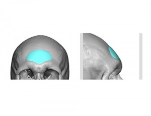 Custom Central Forehead Implant Design Dr Barry Eppley Indianapolis