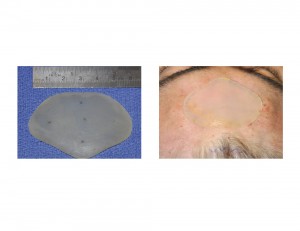 Custom Central Forehead Implant desigtn and location