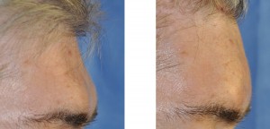 Custom Central Forehead implant intraop side view Dr Barry Eppley Indianapolis