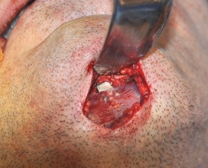 Custom Jawline Implant over sliding genioplasty