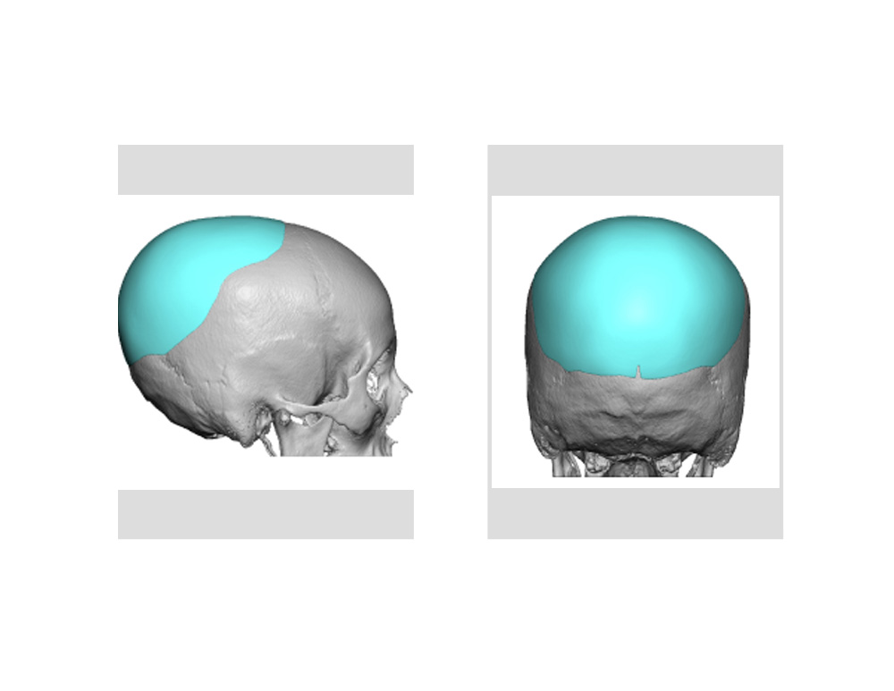 Case Study Flat Back Of The Head Correction With Custom Occipital