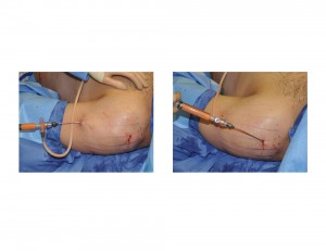 Deltoid (Small Shoulder) Augmnentation by Fat Injections Dr Barry Eppley Indianapolis