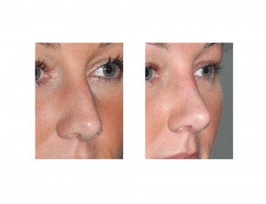 Hump Reduction Rhinoplasty result oblique view Dr Barry Eppley Indianapolis