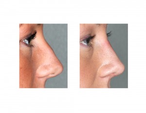 Hump Reduction Rhinoplasty result side view Dr Barry Eppley Indianapolis