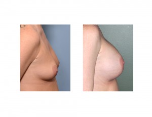 Jennifer Breast Augmentation results side view