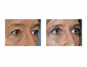 Lower Blepharoplasty without lateral Canthopexy Dr Barry Eppley Indianapolis