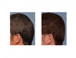 PMMA Bone Cement Occipital Augmentation results side view Dr Barry Eppley Indianapolis