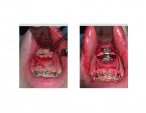 Sliding Geniop[asty intraop technique Dr Barry Eppley Indianapolis