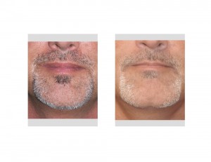 Square Chin Implant with Cleft result Dr Barry Eppley Indianapoliis