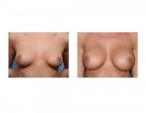 Wide Spaced Breast Augmentation result front view Dr Barry Eppley Indianapolis