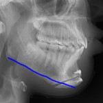 chin reduction osteotomy x-ray with shave line dr barry eppley indianapolis