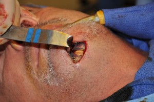 square chin split implant technique dr barry eppley indianapolis
