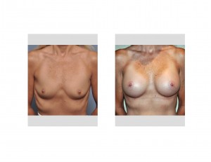 Breast Rejuvenation with Implants front view Dr Barry Eppley Indianapolis