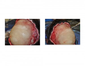 Cranioplasty Pefusion Holes Dr Barry Eppley Indianapolis
