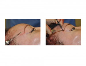 Direct Tail of the Brow Pexy technique Dr Barry Eppley Indianapolis